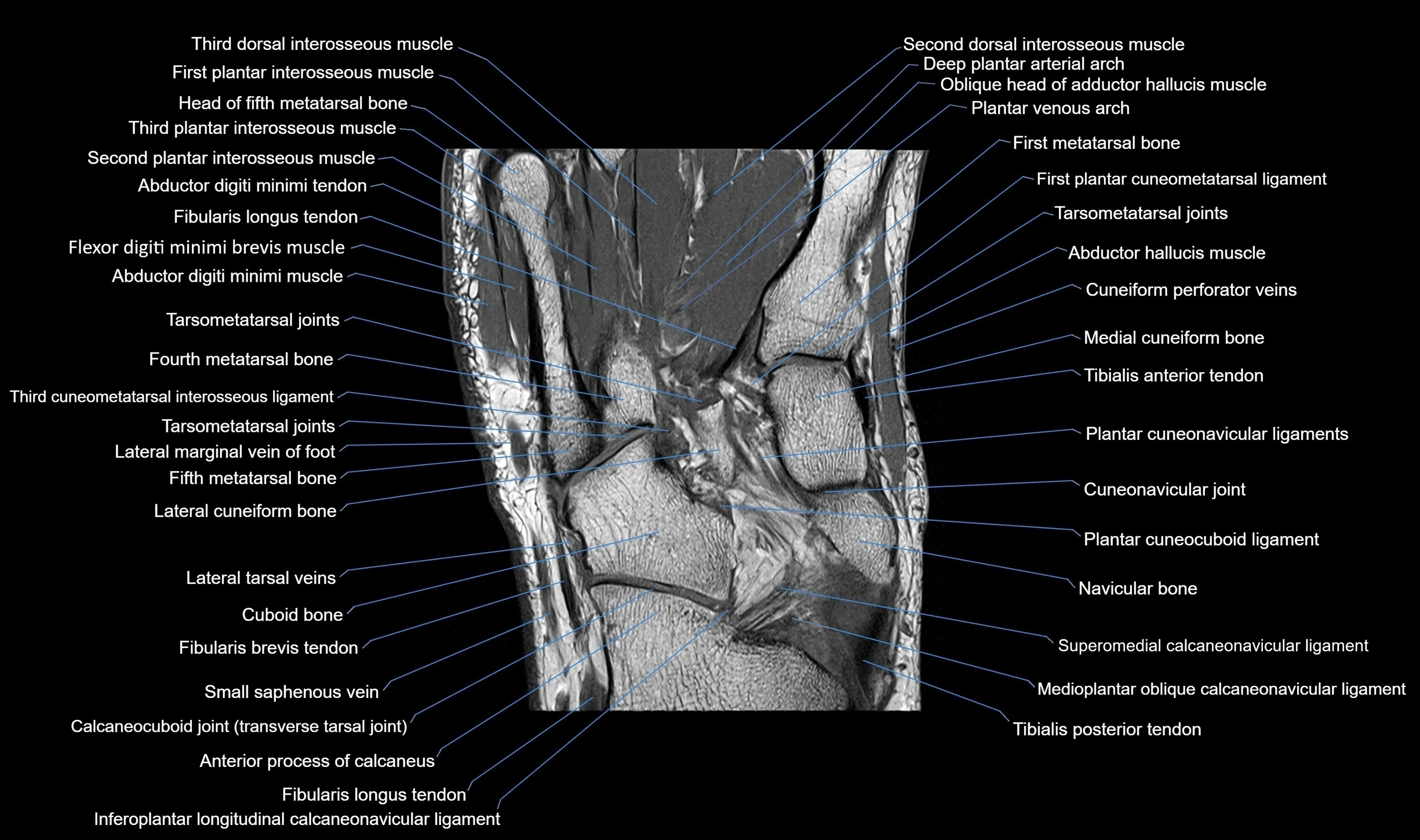 MRI mid foot coronal ligaments cross sectional anatomy 3T  radiology  image-img-00001-00025.webp